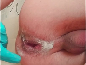 handsome skinny twink with ruptured prolapse makes fisting to himself japan gay porn ona collection